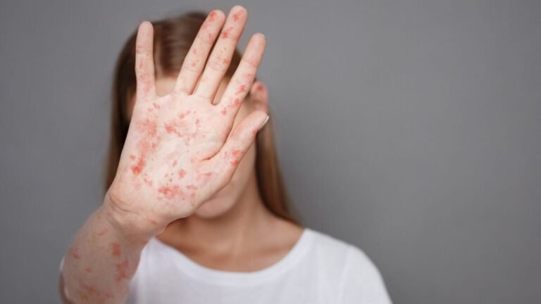 The Ongoing Measles Outbreak Has Reached a New Peak