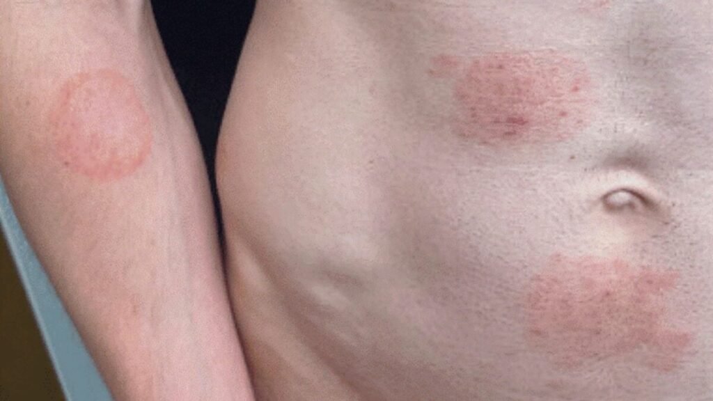 A STI Fungus Is Making Itself Cozy in the US