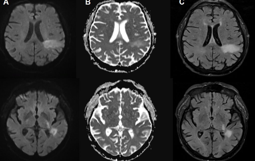 You’re likely already infected with a brain-eating virus you’ve never heard of You're likely already infected with a brain-eating virus you've never heard of